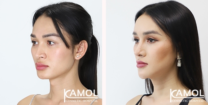 Facial Feminization Surgery