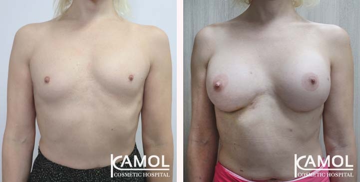 Male to Female Breast Surgery