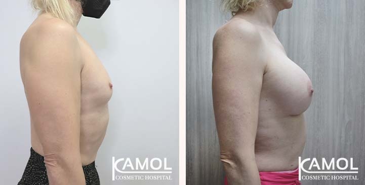 Male to Female Breast Surgery