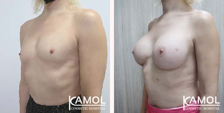 Male to Female Breast Surgery
