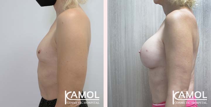 Male to Female Breast Surgery