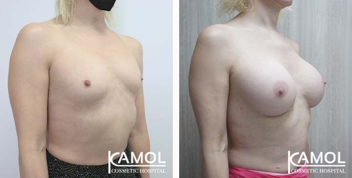 Male to Female Breast Surgery