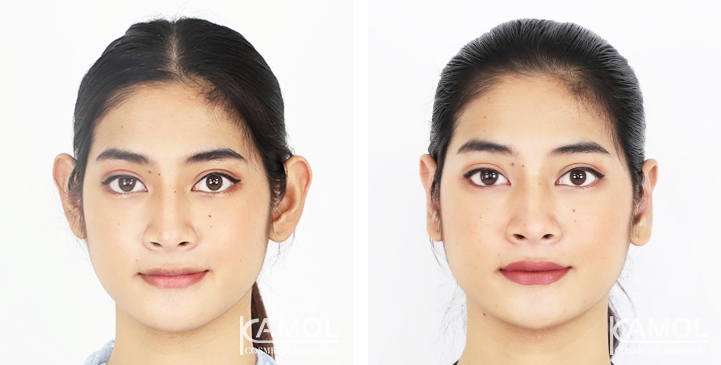 Before & After for Ear surgery