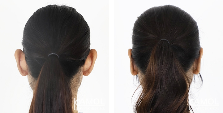 Before & After for Ear surgery