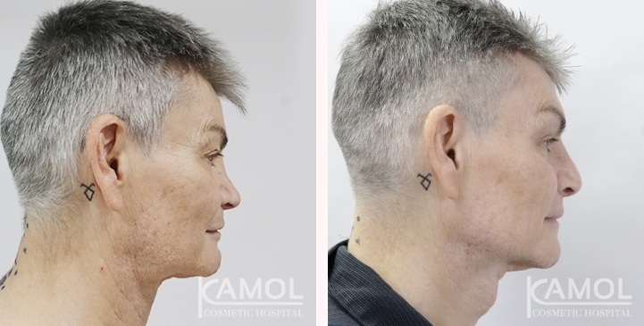 Before & After Masculin Nose, Jaw Augmentation, Chin Augmentation, Adam's Apple Augmentation, Left side view