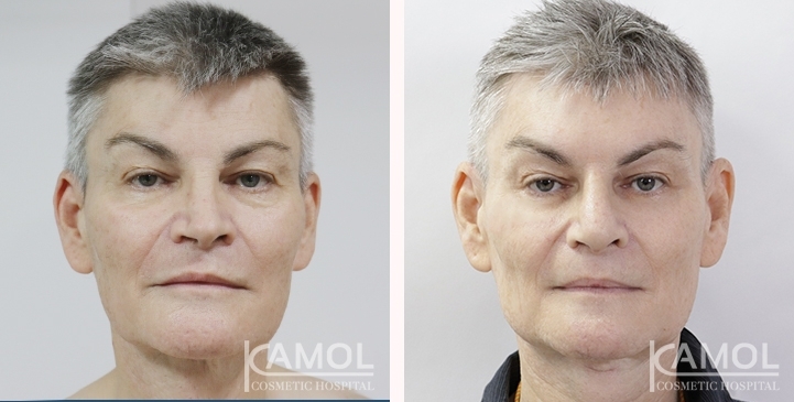 Before & After Masculin Nose, Jaw Augmentation, Chin Augmentation, Adam's Apple Augmentation, Left side view