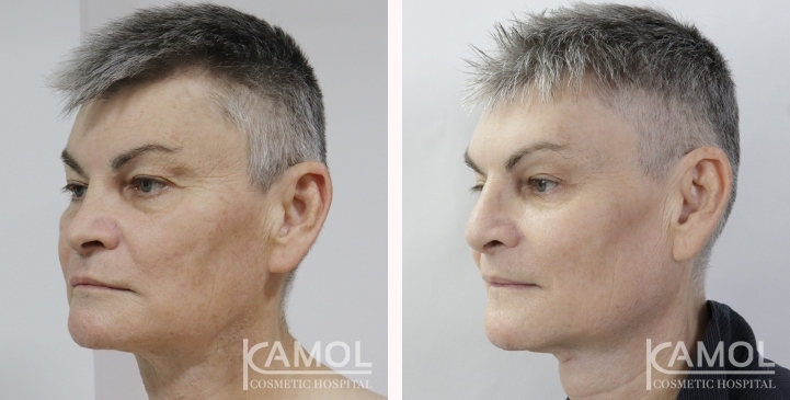 Before & After Masculin Nose, Jaw Augmentation, Chin Augmentation, Adam's Apple Augmentation, Left side view