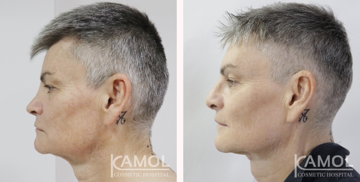 Before & After Masculin Nose, Jaw Augmentation, Chin Augmentation, Adam's Apple Augmentation, Left side view