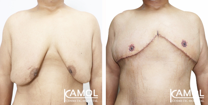 Gynecomastia Surgery