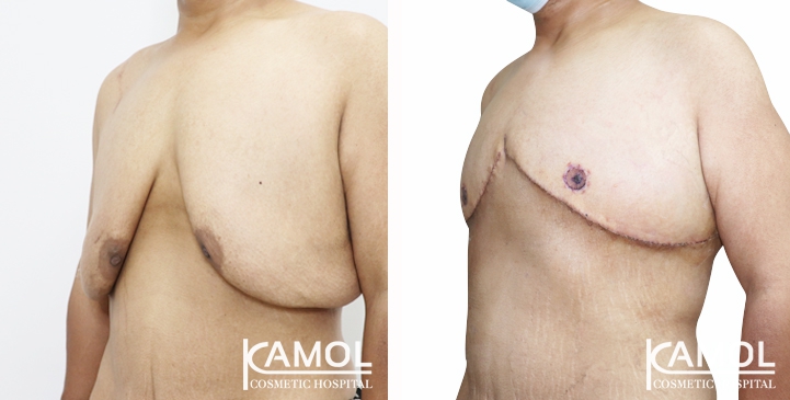 Gynecomastia Surgery
