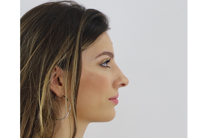 Revision Rhinoplasty