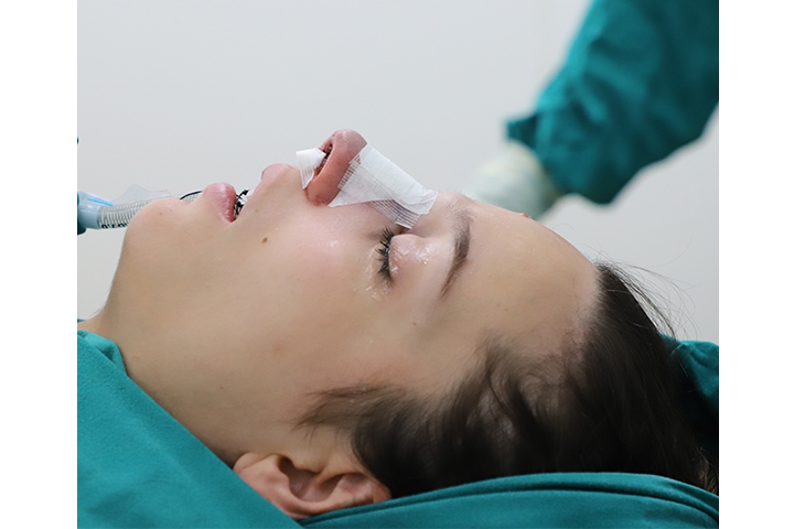 Revision Rhinoplasty