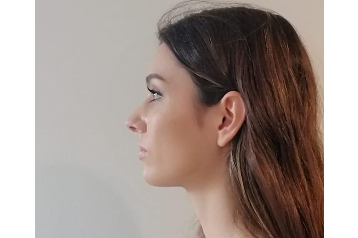 Revision Rhinoplasty