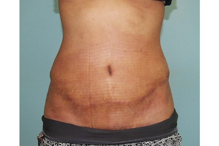 Подтяжка живота