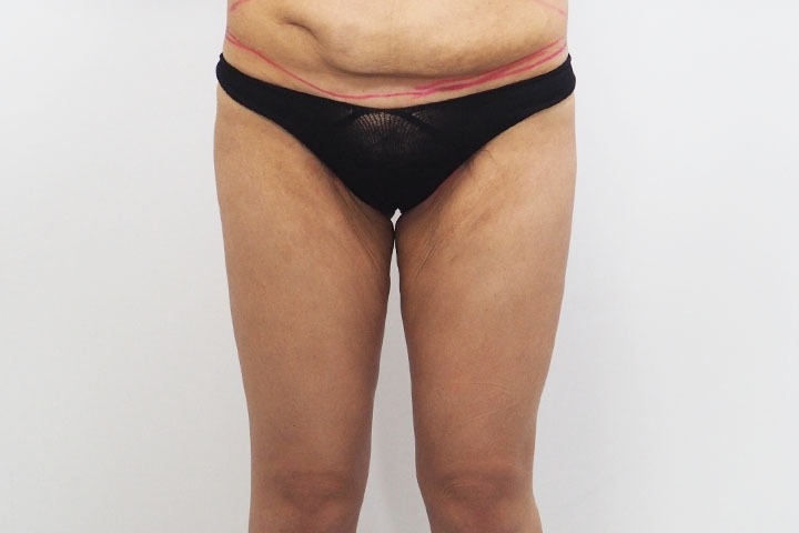 Thigh Lift