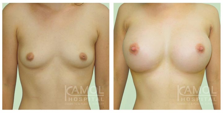 BreastAugmentation-7