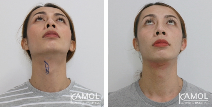 lg-6494958a891a4-image