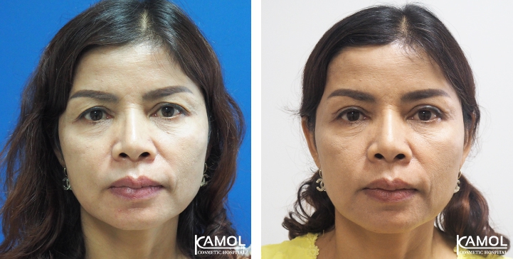 lg-6494958eeb60d-image