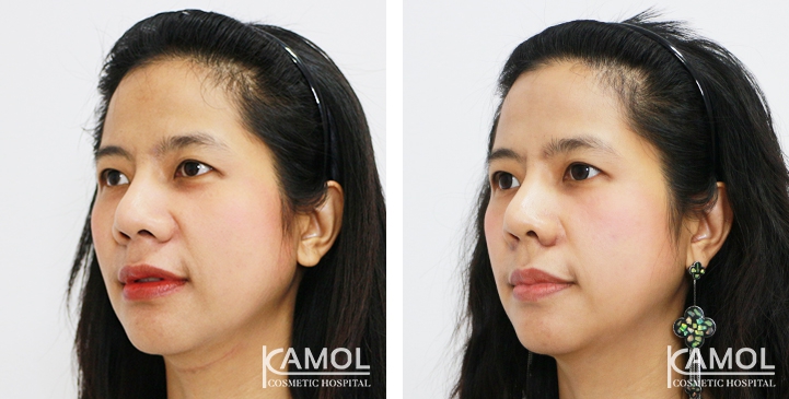 lg-6494958f27c16-image