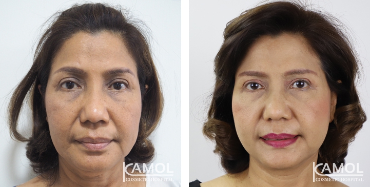 lg-6494958f82886-image