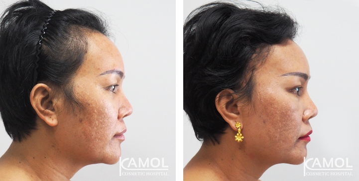 lg-649495957bcbb-image