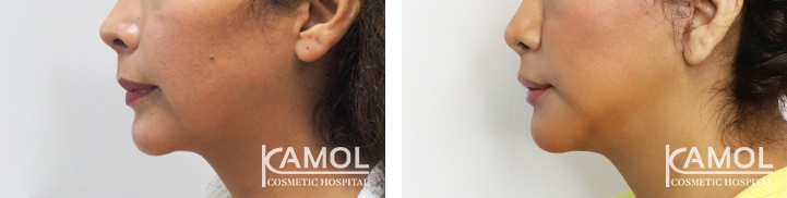 lg-64949595ae3d3-image