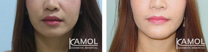 lg-64949595c193a-image