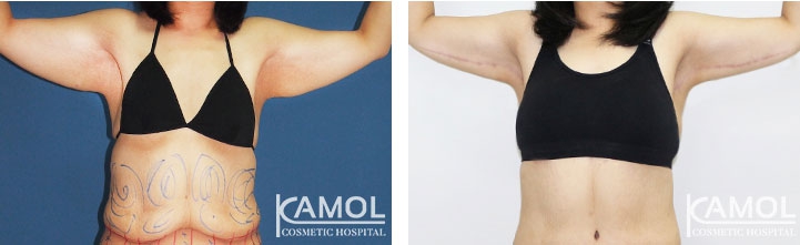 lg-6494959c18660-image