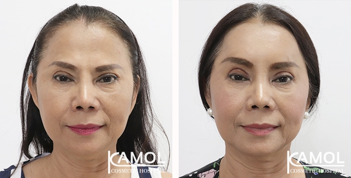 lg-65310b804f30b-image