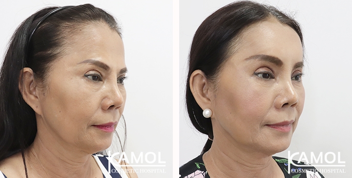 lg-65310b807bb1f-image