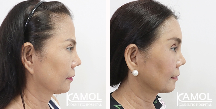 lg-65310b80a3633-image