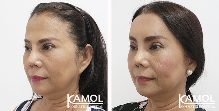 lg-65310b80e79fe-image