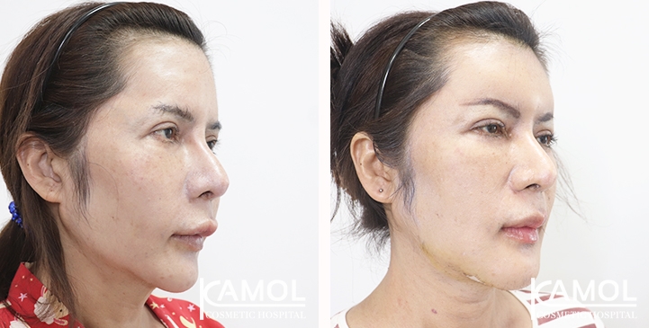 lg-6532226bd91b1-image