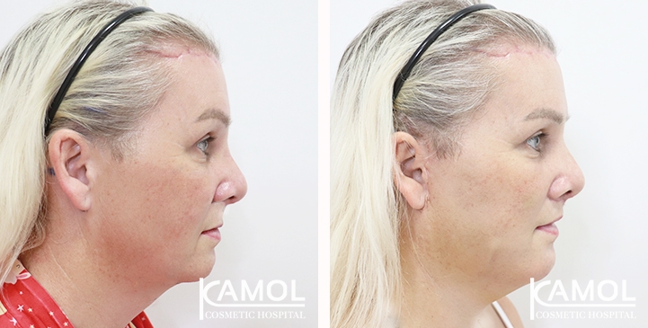 lg-654075f16aa83-image