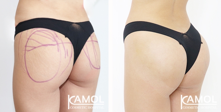 lg-65eec8a0ef443-image