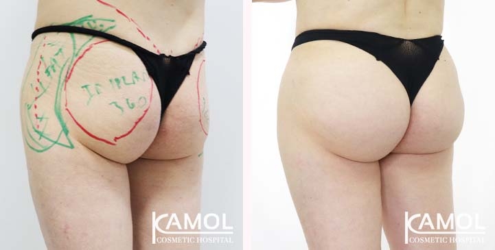 lg-65eeca4df2d69-image